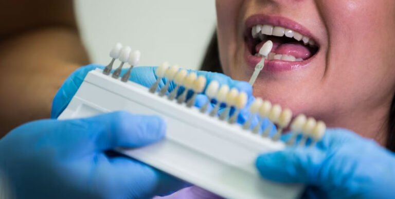 Precisa desgastar os dentes para colocar lente de contato? 1 lente contato123