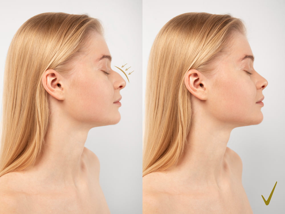 Quanto tempo demora a recuperação após a rinoplastia? 4 rinoplastia antes depois