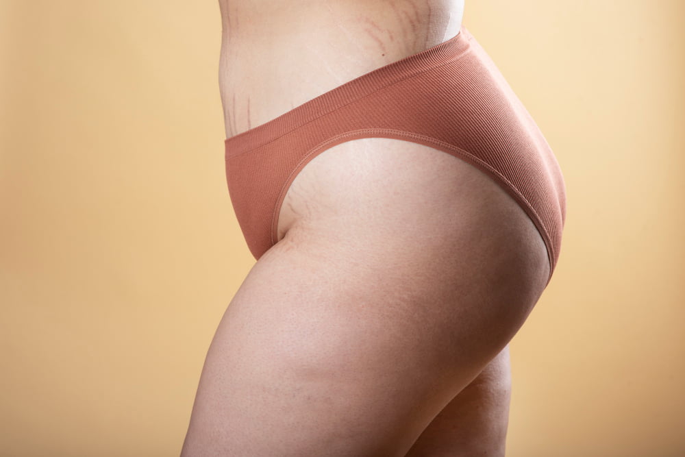 Suplementos para Remover Estrias: Quais os melhores? 2 estrias