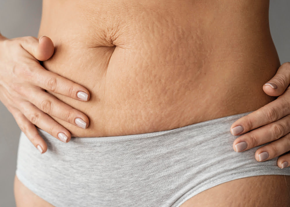 Suplementos para Remover Estrias: Quais os melhores? 3 evitar Estrias