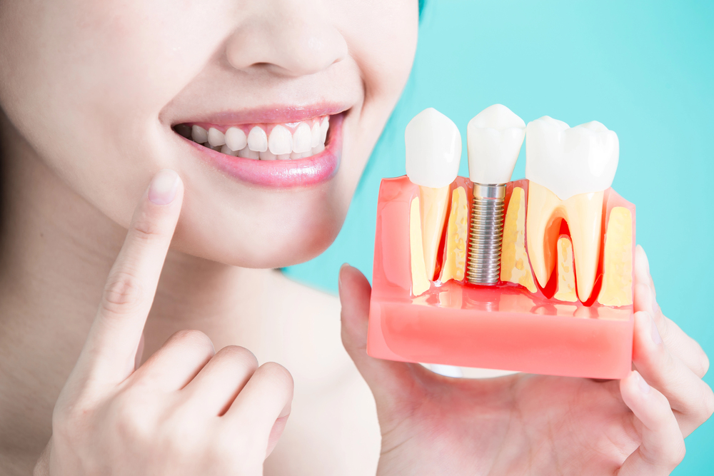 Quais são os benefícios dos implantes de dentes? 4 Implantodontia 2