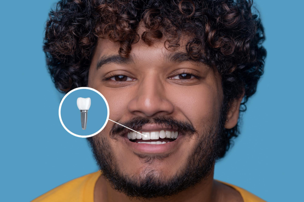 Quais são os benefícios dos implantes de dentes? 3 beneficios dos implantes de dentes