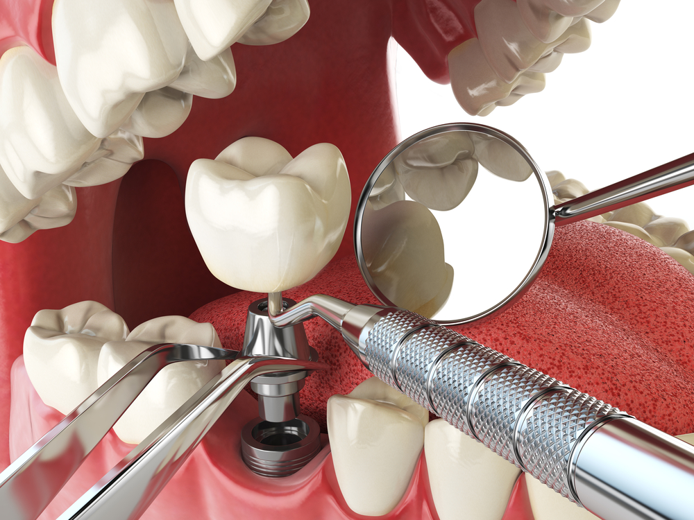 Quais são os benefícios dos implantes de dentes? 2 implante