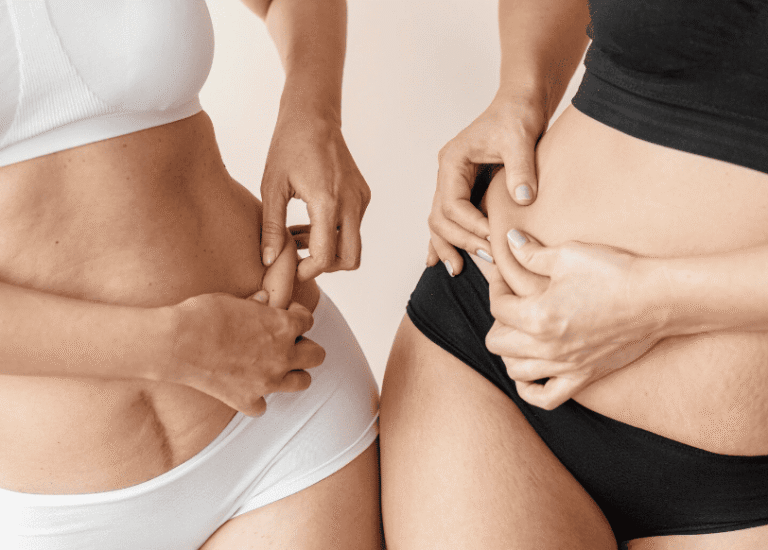 Tratamentos para celulite e gordura localizada: o que realmente funciona? 3 Tratamentos para celulite