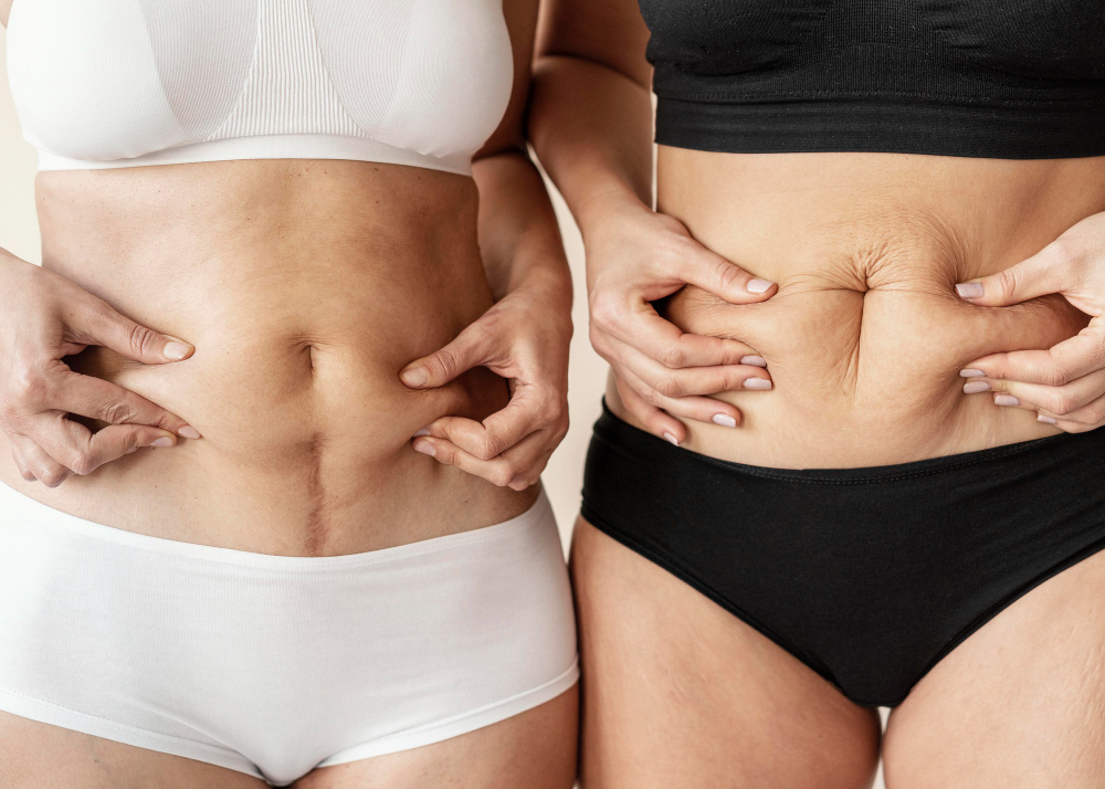 Barriga não é só estética: por que cuidar da sua saúde vai muito além da aparência 2 barriga